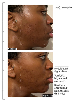 Deluxe Mandelic Pigmentation Corrector Night Serum, 8ml